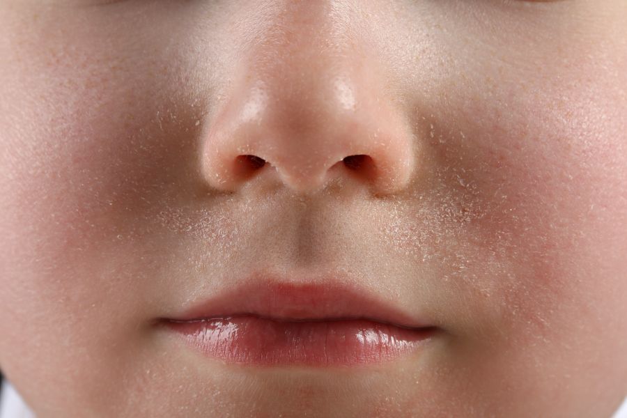 closeup of child's face with dry skin